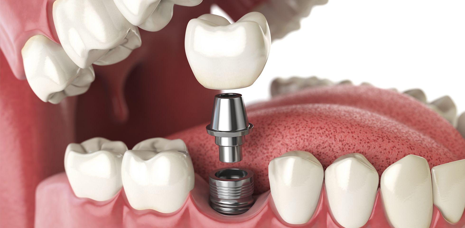 titanyum vida implantı